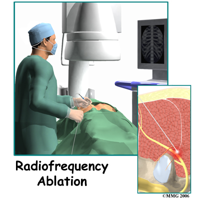 Radiofrequency Ablation